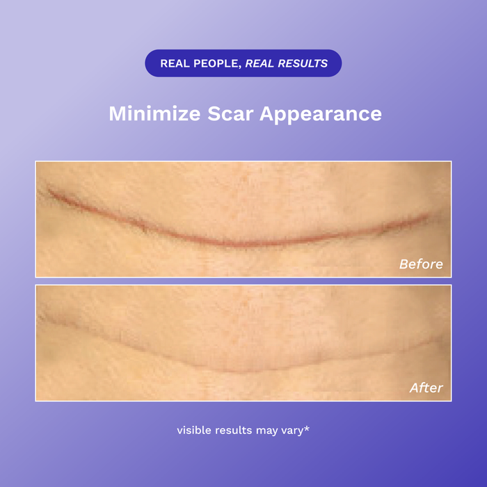 Scar Fx silicone sheeting product image 5